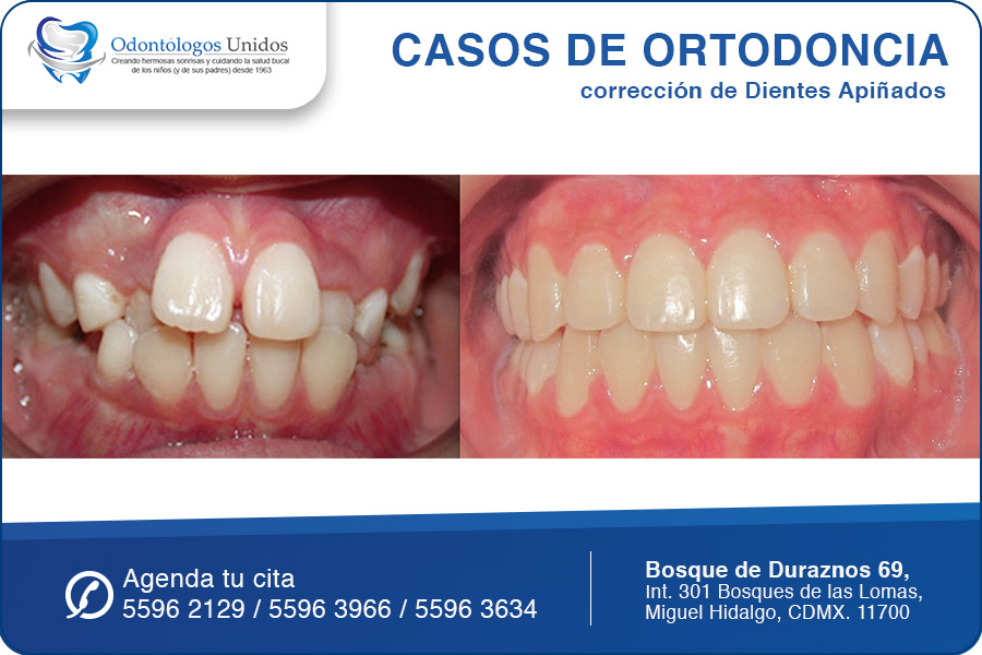 ¿Cómo corregir Dientes Chuecos o Apiñados?