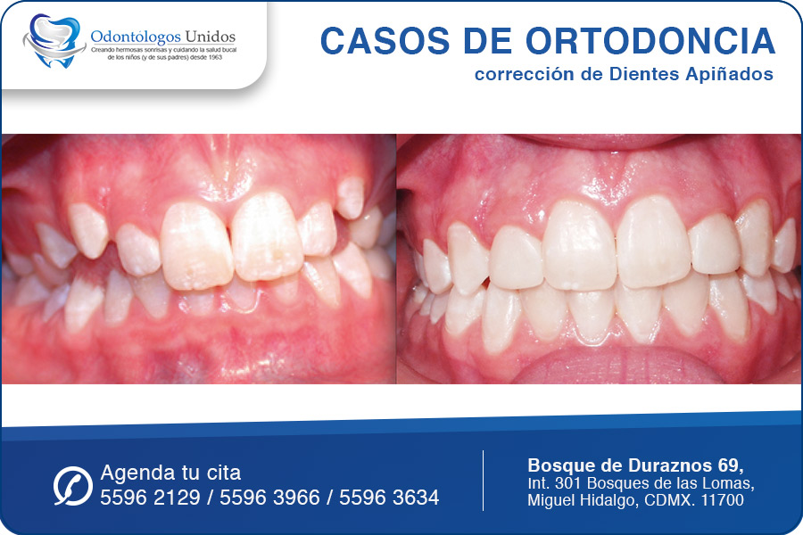 Dientes Apiñados