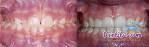 casos de exito ortodoncia temprana