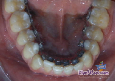 Ortodoncia Lingual Antes y Después