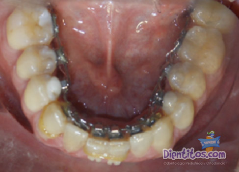 Ortodoncia Lingual Antes y Después