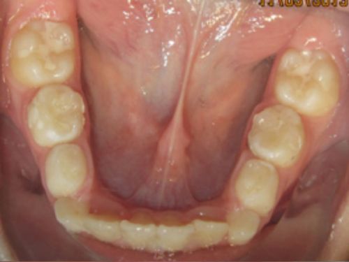 ortodoncia-temprana2