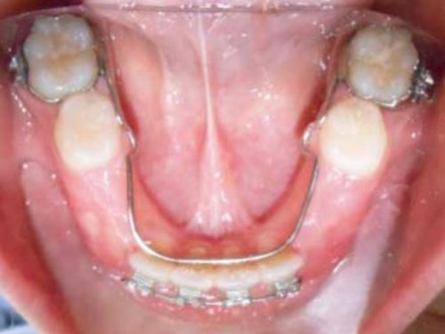 ortodoncia-temprana4