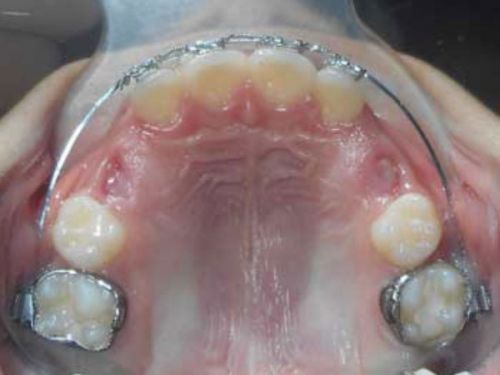 ortodoncia-temprana5